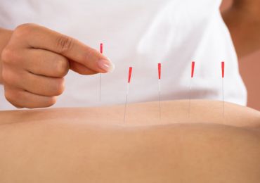 dry-needling